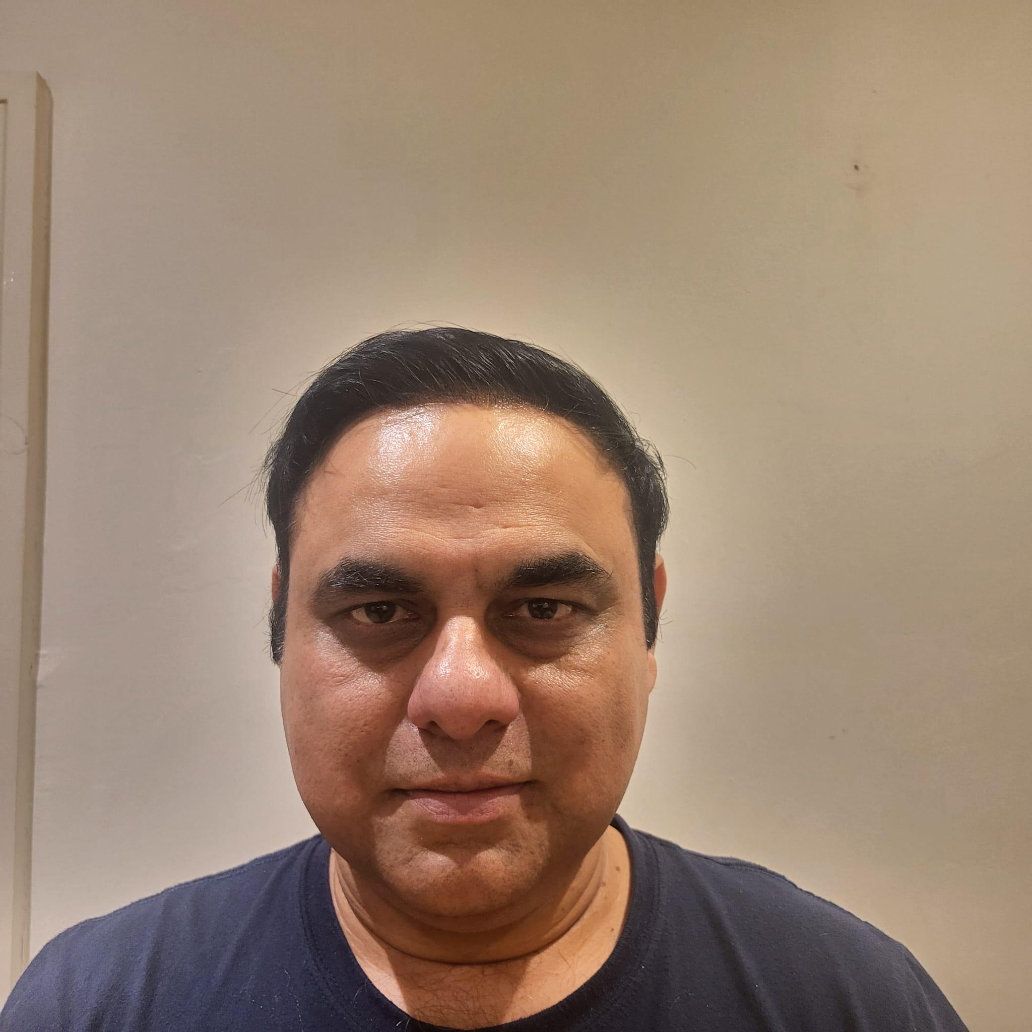 Nishant hair transplant result photo 7